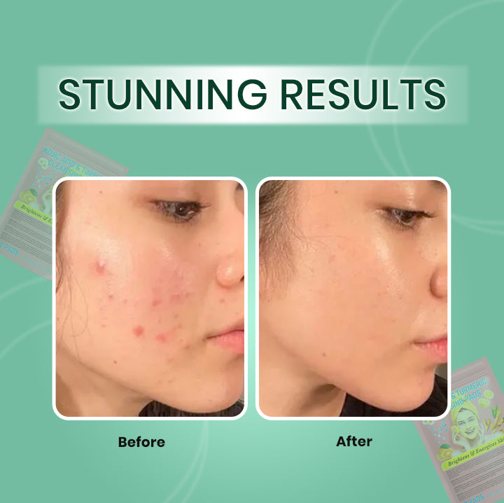 Cleaning Pads : Turmeric & Kojic Acids ( Buy 1 Get 1 Free )