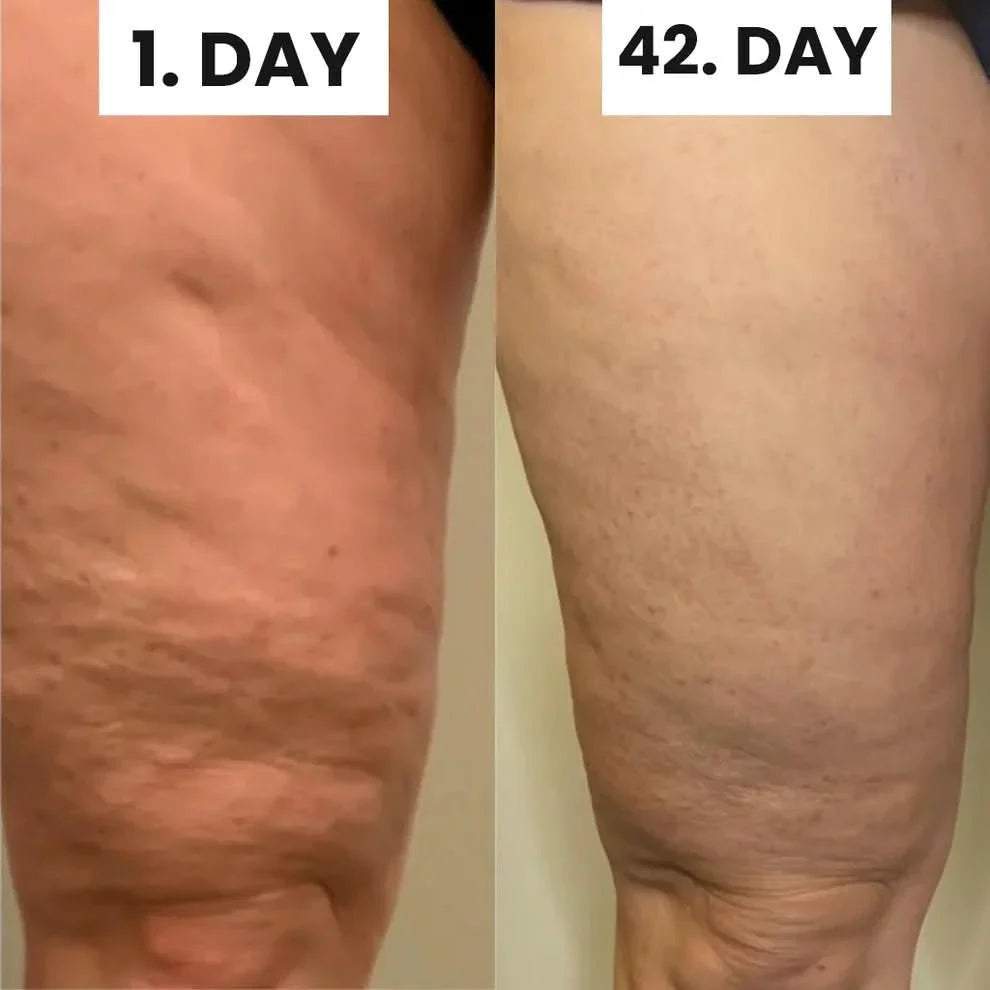 Blaire™ Cellulite Relief Kit