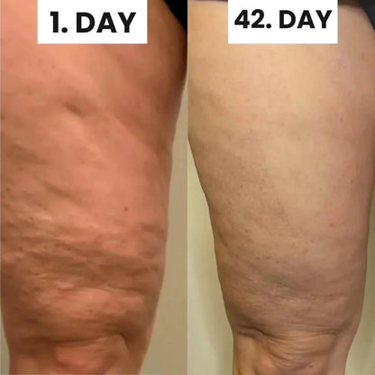 Blaire™ Cellulite Relief Kit