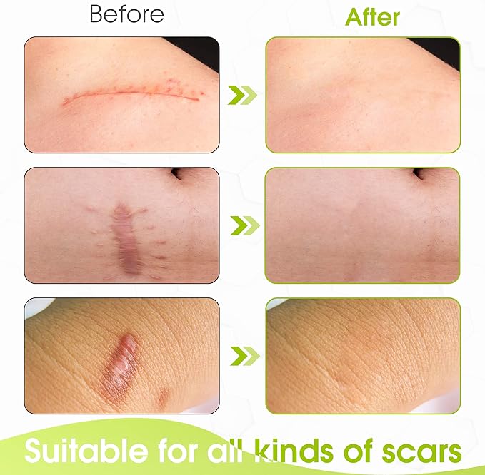 Silicone Scar Sheets