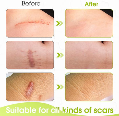Silicone Scar Sheets