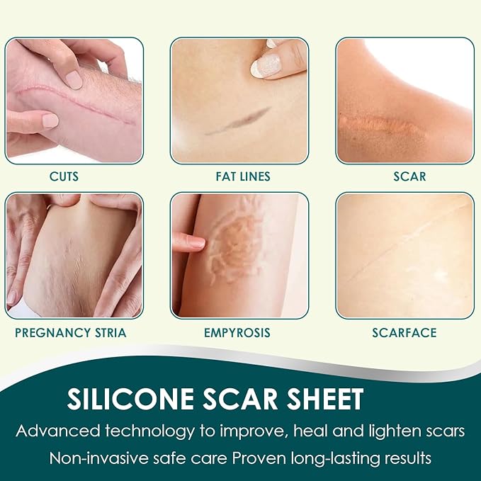 Silicone Scar Sheets