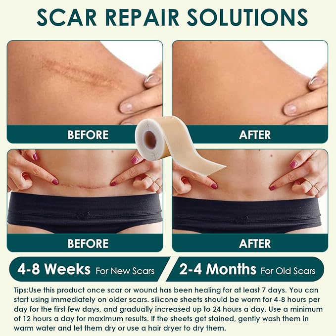 Silicone Scar Sheets