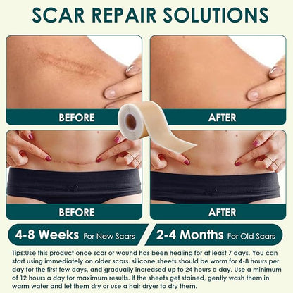 Silicone Scar Sheets